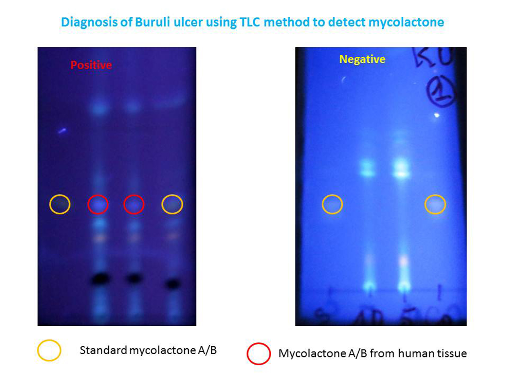 Simple test promises early diagnosis of debilitating skin disease