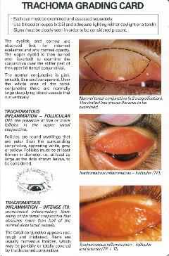 Trachoma-simplified-grading-card-verso-Eng Trachoma-simplified-grading-card-verso-Eng