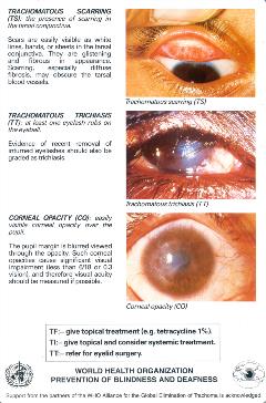 Trachoma-simplified-grading-card-verso-Eng Trachoma-simplified-grading-card-verso-Eng